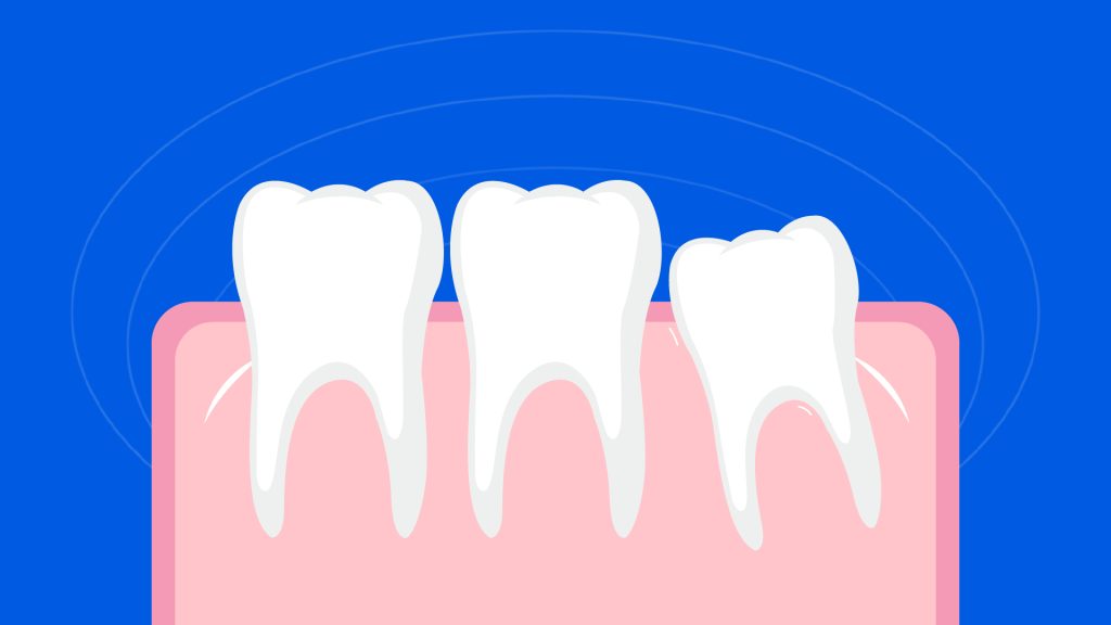 Wisdom teeth erupting sideways to collide with adjacent teeth and cause pain