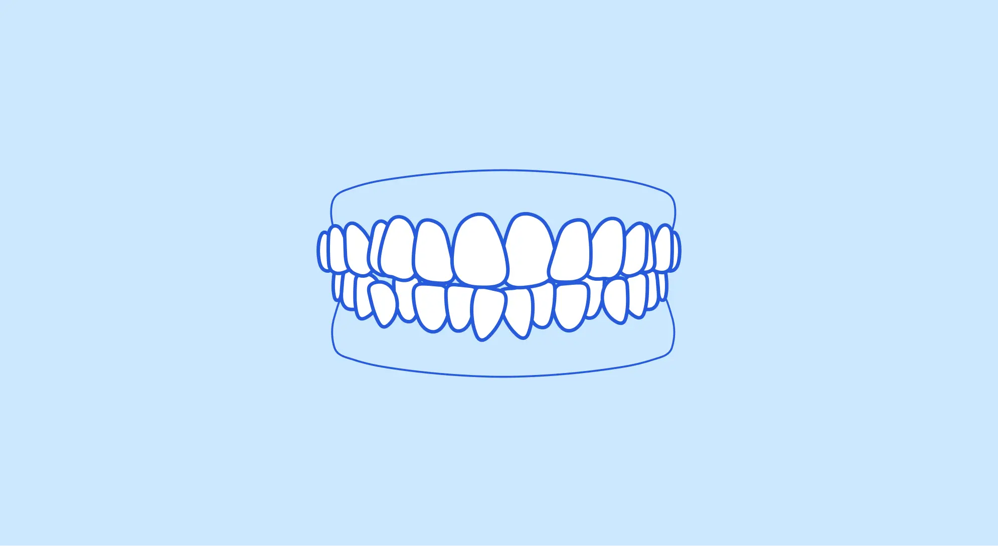 Illustration of overlapping front teeth and crowded bottom teeth.