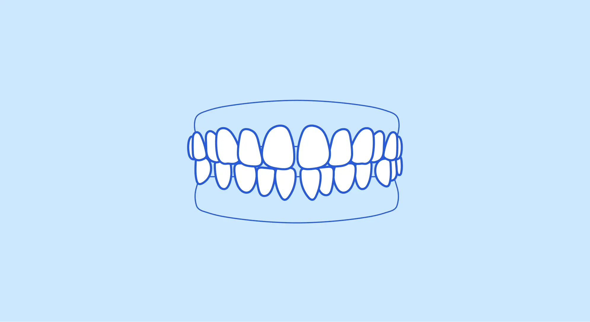 Illustration of a set of teeth with gaps between them.