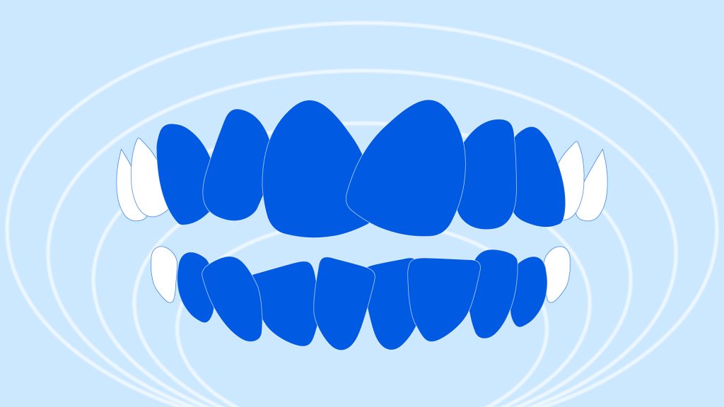 A visual showing crowded teeth.