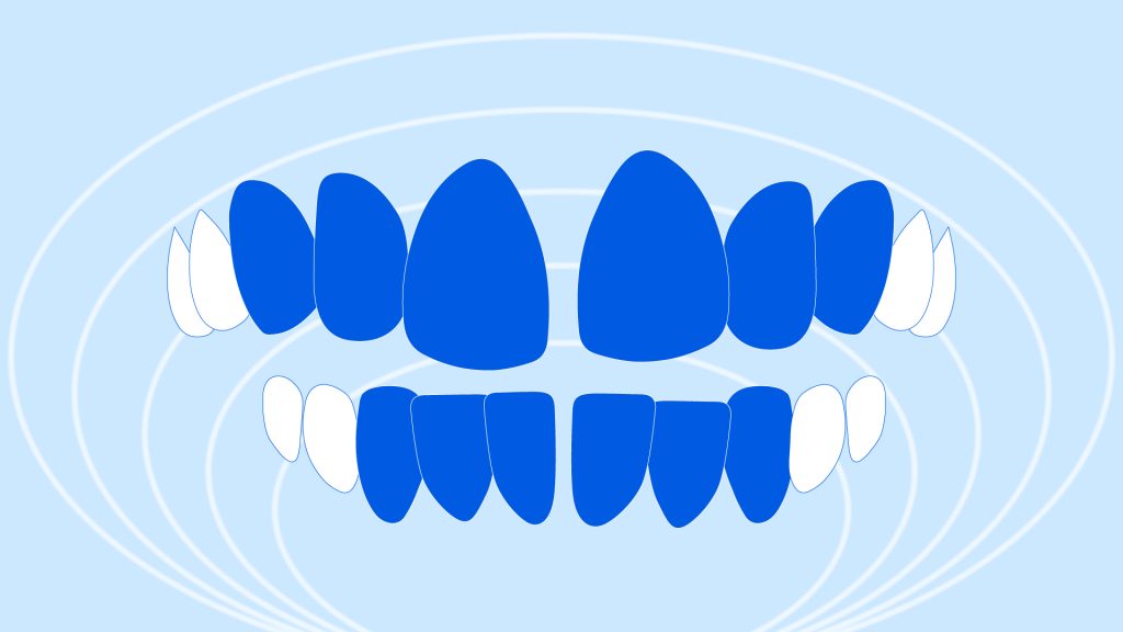 A teeth illustration showing gaps between front teeth and bottom row of teeth.