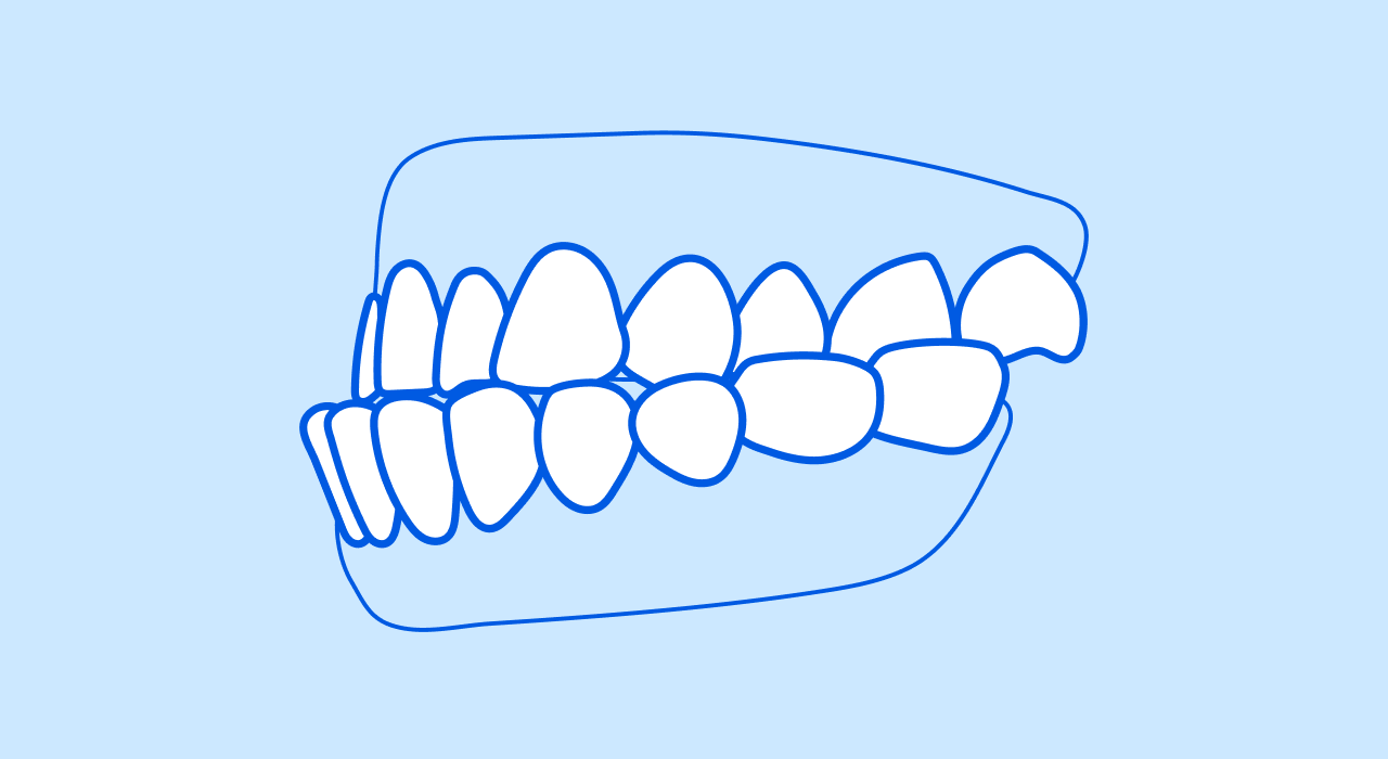 Underbite teeth condition that can be treated with braces like Zenyum