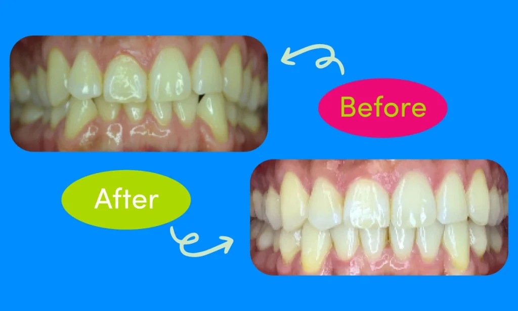 Before and after images of overbite patient