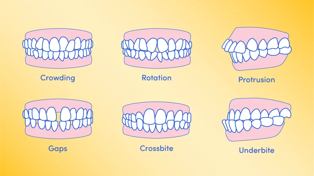 Malocclusions - signs you might need braces