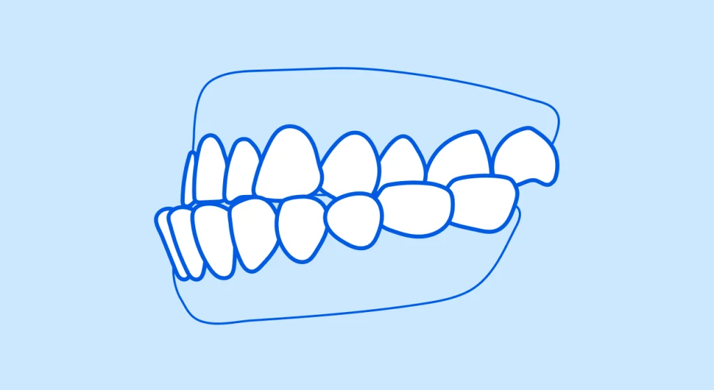 Underbite teeth condition that can be treated with braces.