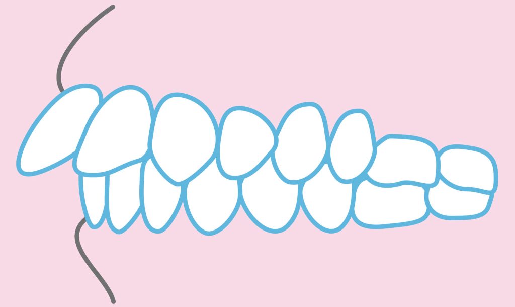 出っ歯とは？