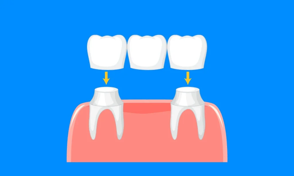 Digital illustration of how dental bridge is attached