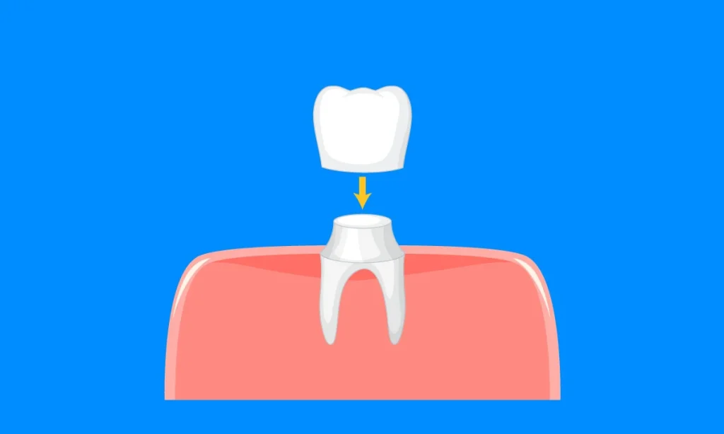 Digital illustration of how a dental crown is attached