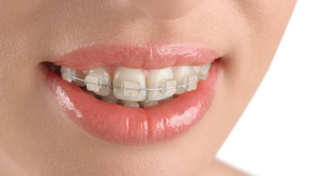 ceramic braces price