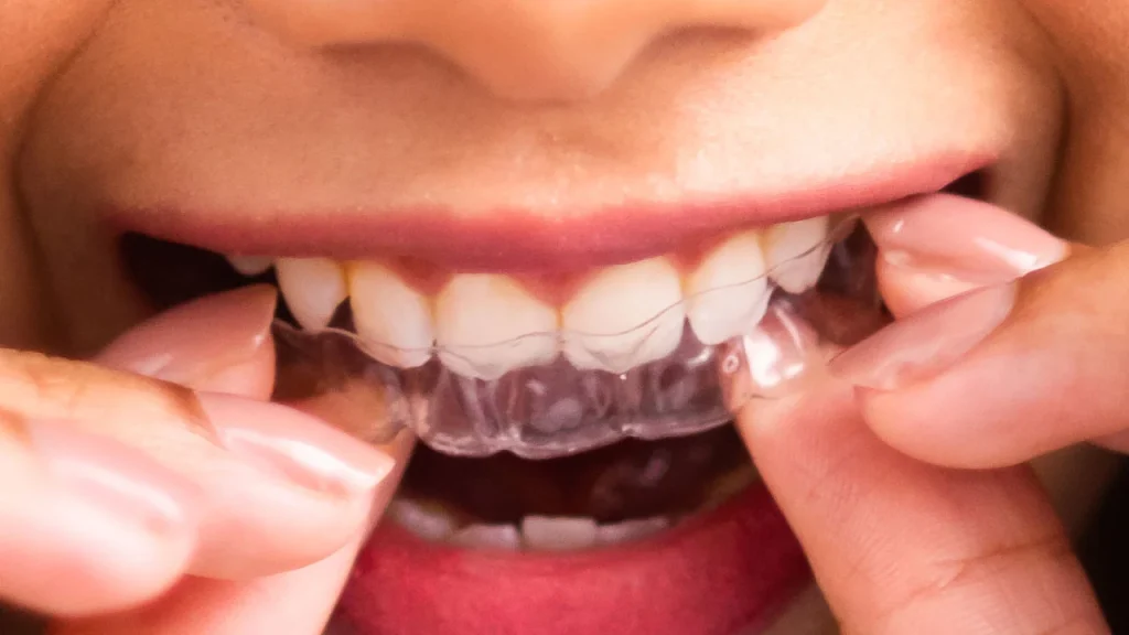 invisible braces vs metal braces