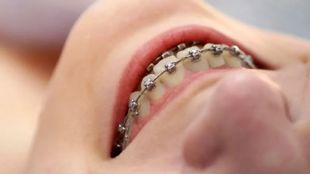 Person smiling with self-ligating/damon braces