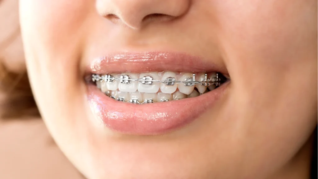 Teeth straightening with traditional metal braces