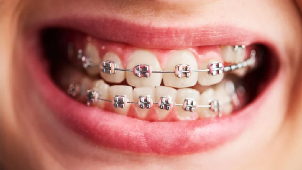 metal braces for crowded teeth