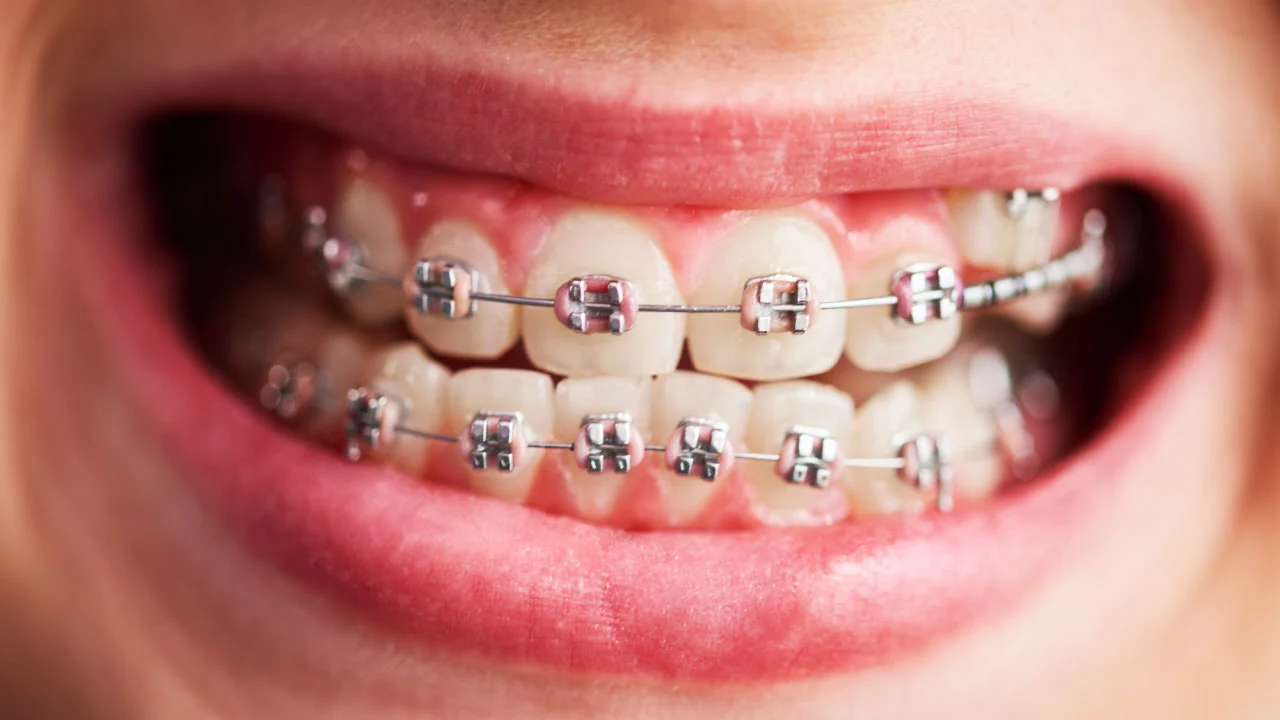 metal braces cost process