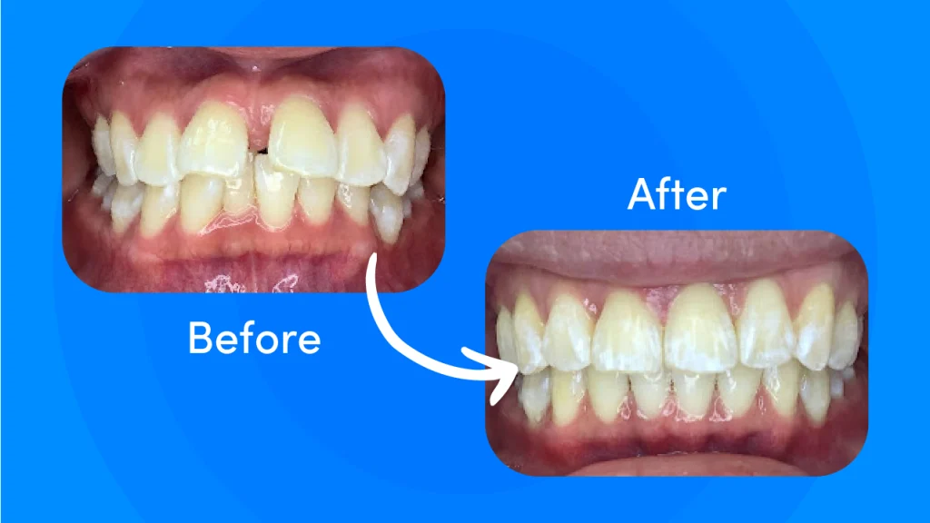 Before and after Zenyum clear aligners