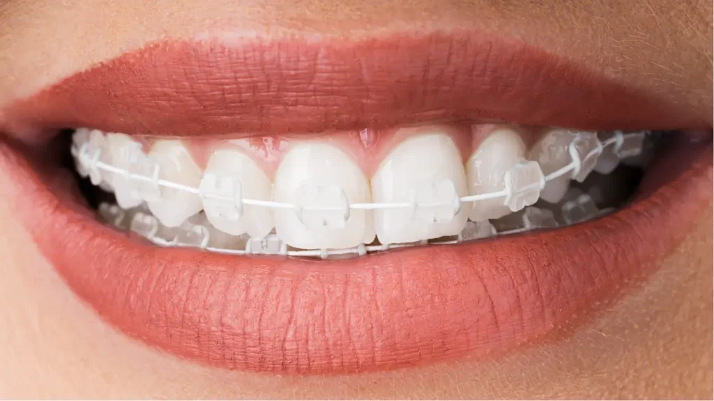 Lingual braces vs ceramic braces