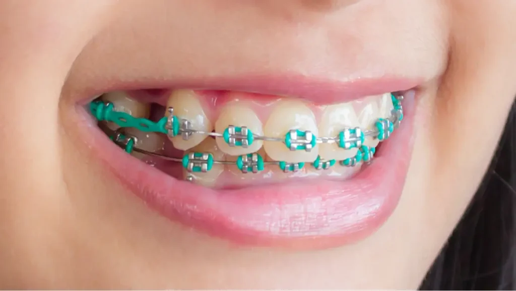 Lingual braces vs metal braces