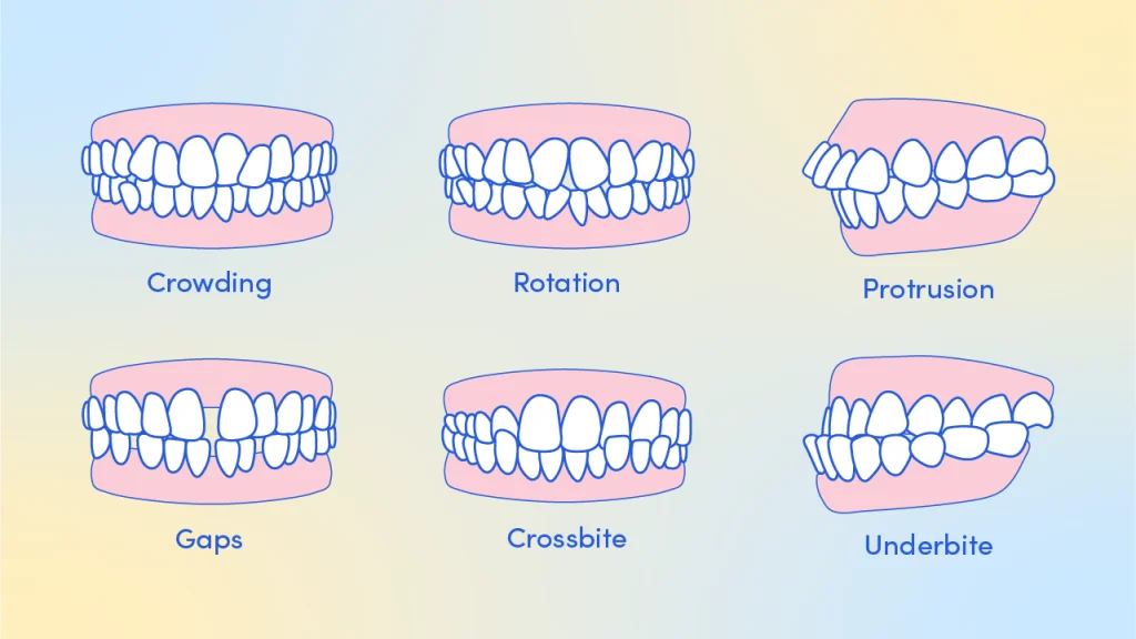 teeth conditions that clear aligners can help fix