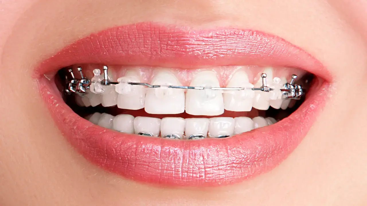 Self-ligating braces or otherwise called damon braces fixed on teeth