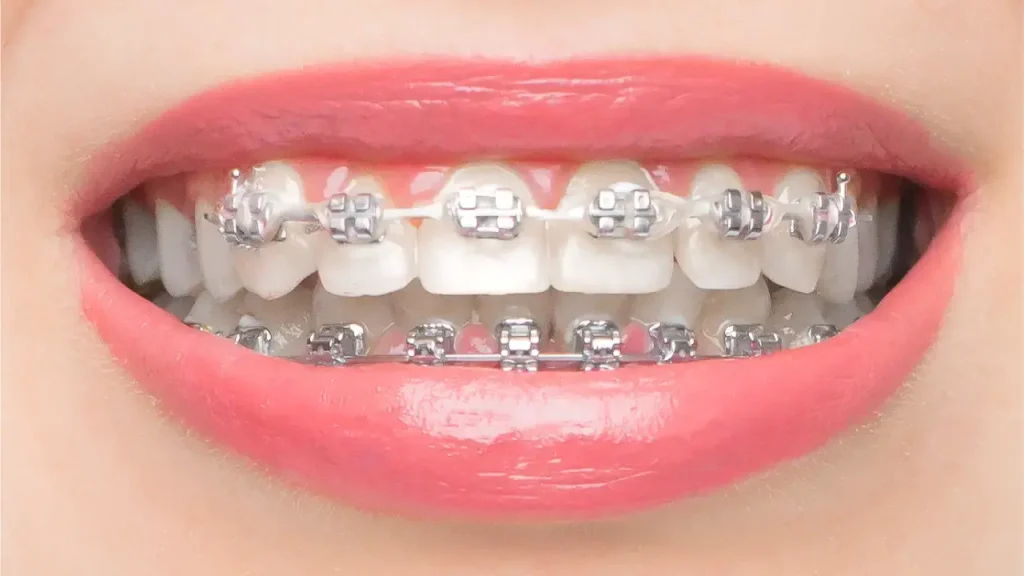 Self-ligating braces on white teeth with a smile