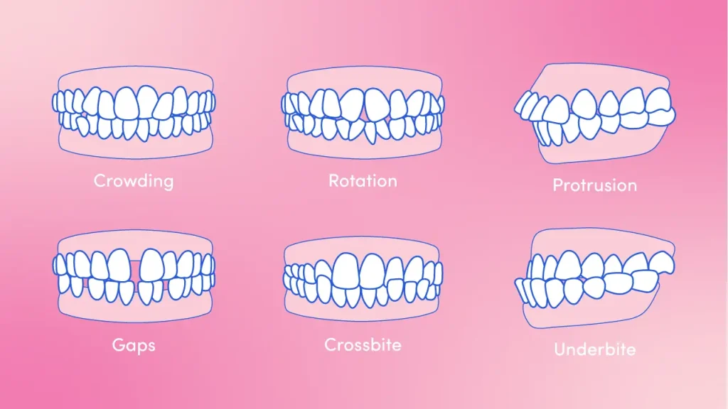 Teeth conditions that can be treated by lingual braces