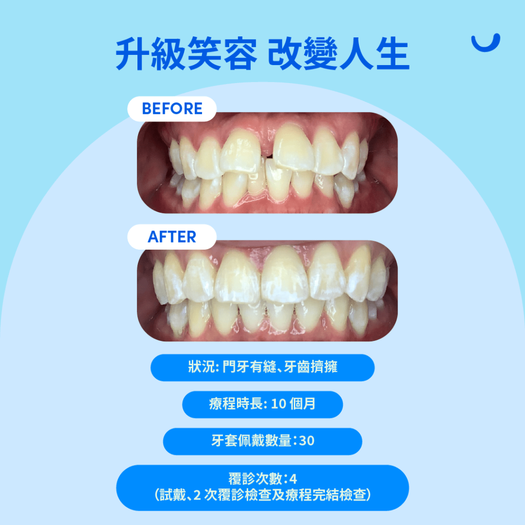 Zenyum 隱形牙箍 before and after