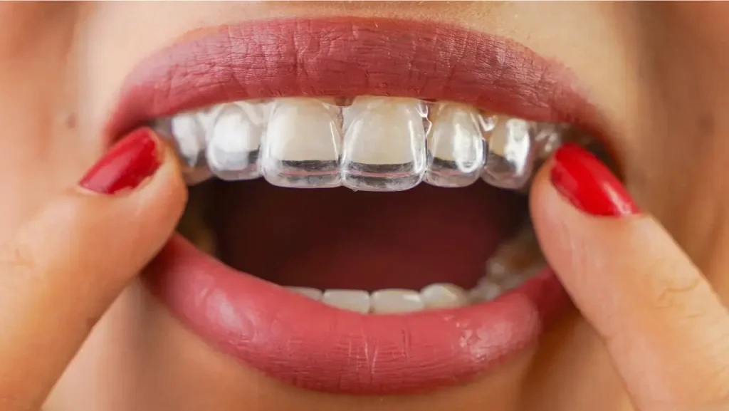 Invisible braces over white teeth