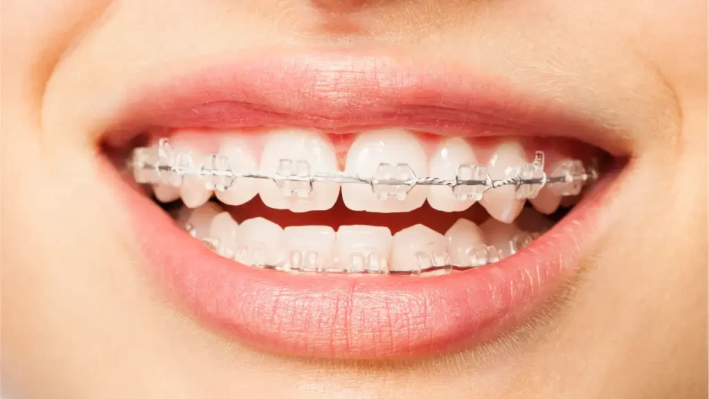 Whitened teeth while wearing ceramic braces