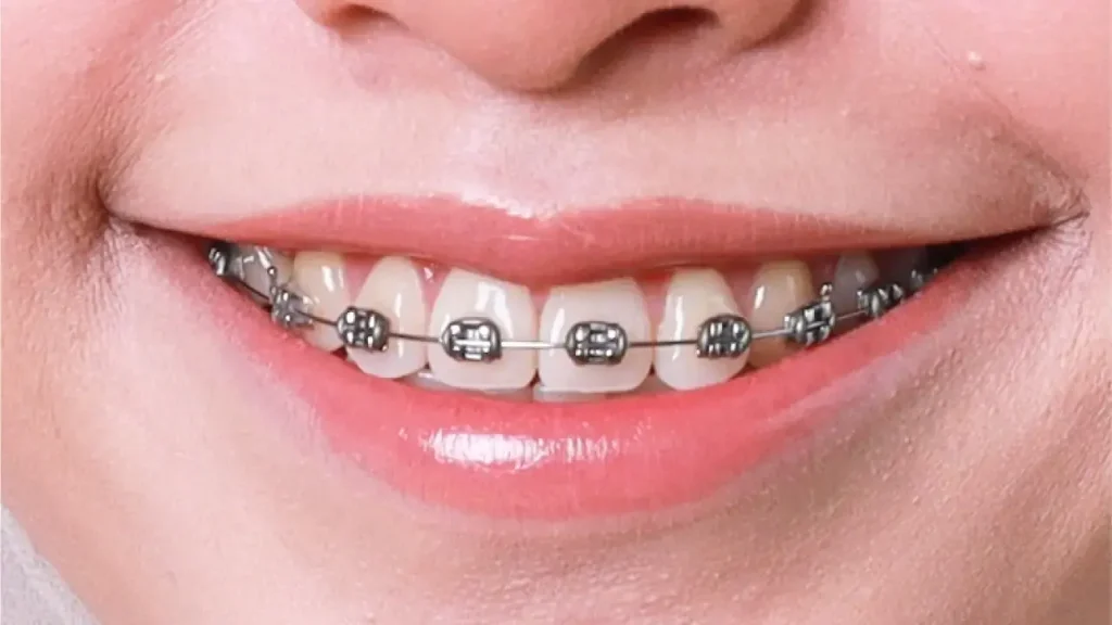 Whitened teeth covered by metal braces