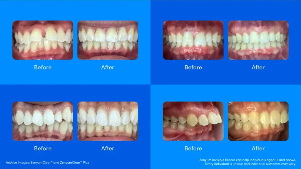 Before and after of Zenyum customers