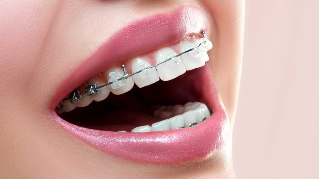 Self-ligating braces