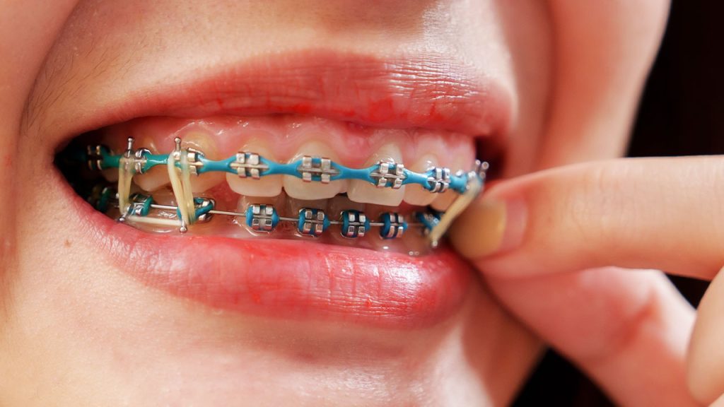 Braces with rubber brand