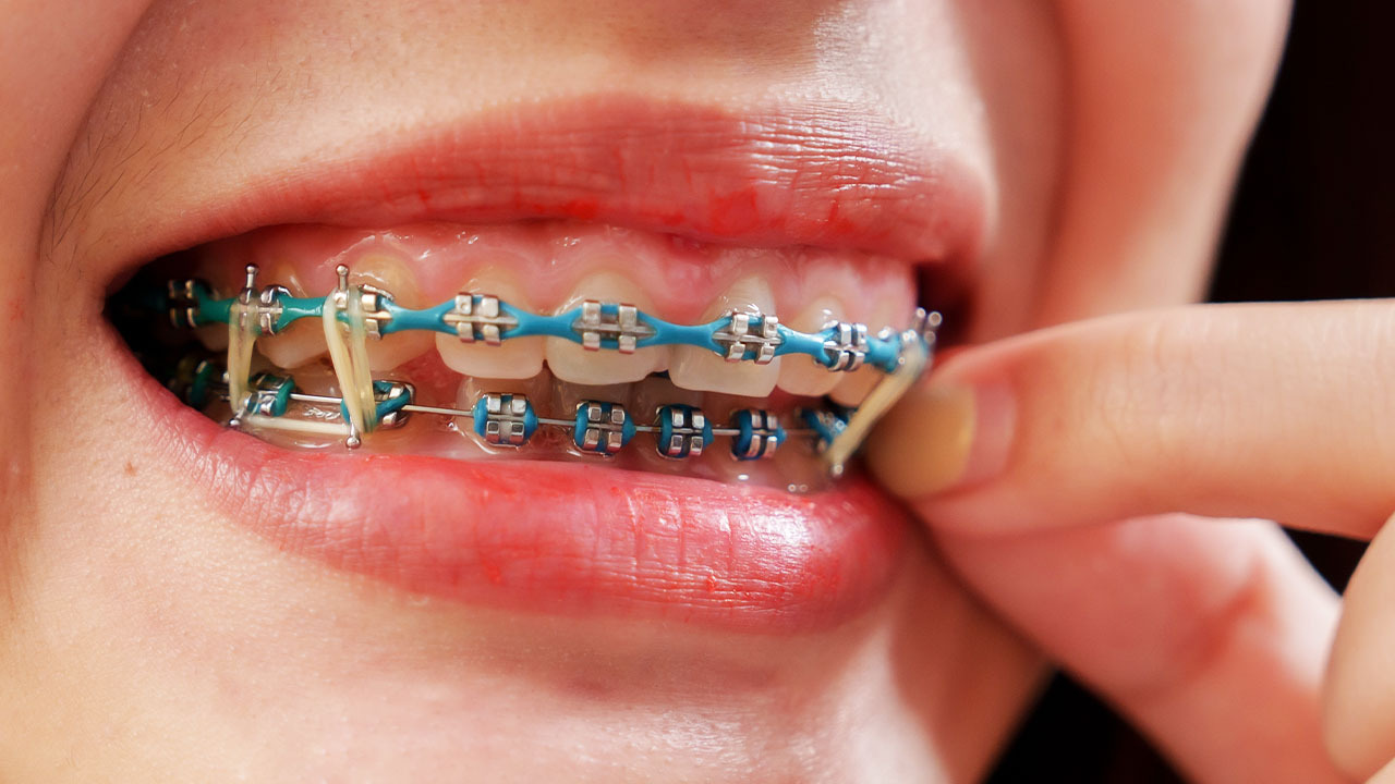 Braces with rubber brand