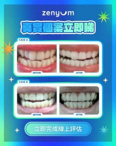 Zenyum 隱形牙套用家箍牙前後對比圖