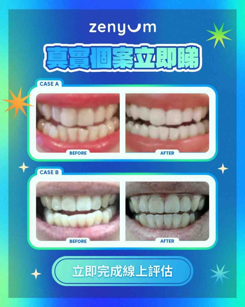 Zenyum 開咬矯正案例