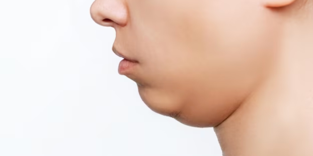 下巴後縮示意圖