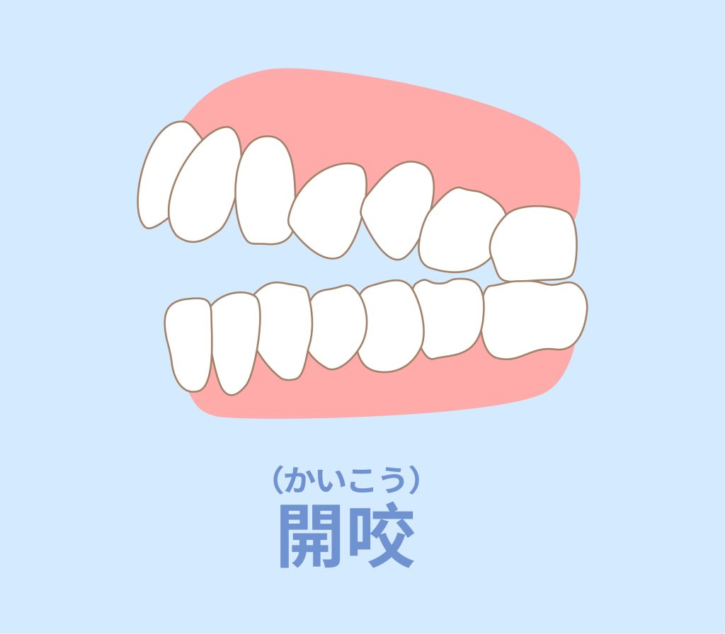 開咬示意圖