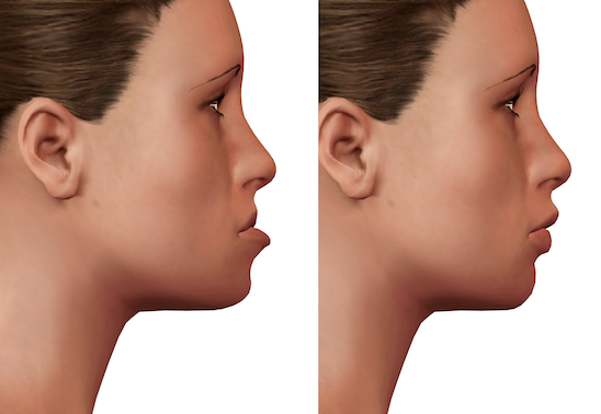 正顎手術 before &after