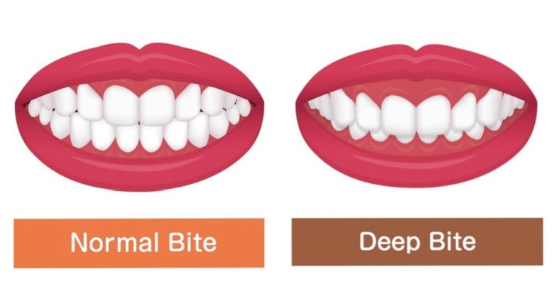 深咬是什麼？