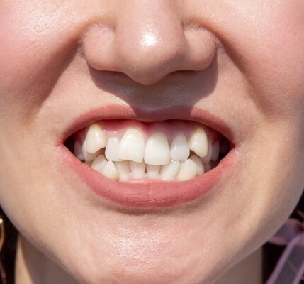 2. 牙齒排列問題與缺牙