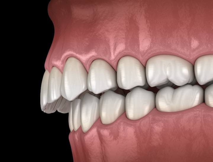 嘴突或骨性暴牙,擔心無法改善臉型