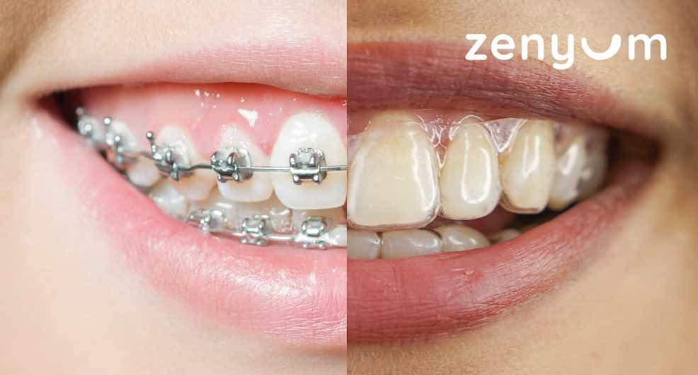 隱形牙套與傳統牙套箍牙流程時間比較