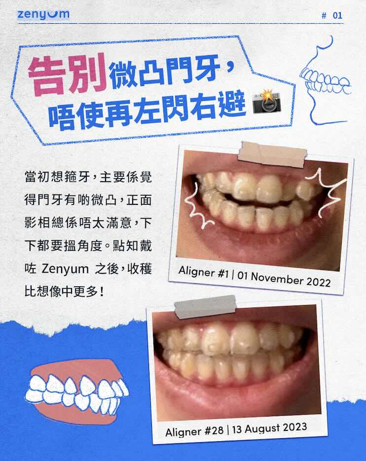 Zenyum 門牙微凸 Before After 對比