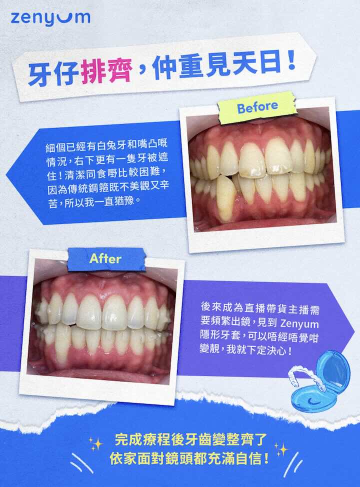 Zenyum 嚴重擠擁與白兔牙 Before After 對比