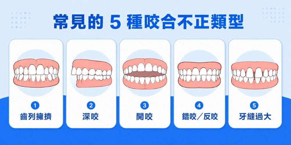 5種常見咬合不正類型